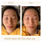 Before and after comparison of a woman's eyes undergoing a rejuvenation therapy.