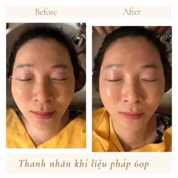 Before and after comparison of a woman's eyes undergoing a rejuvenation therapy.